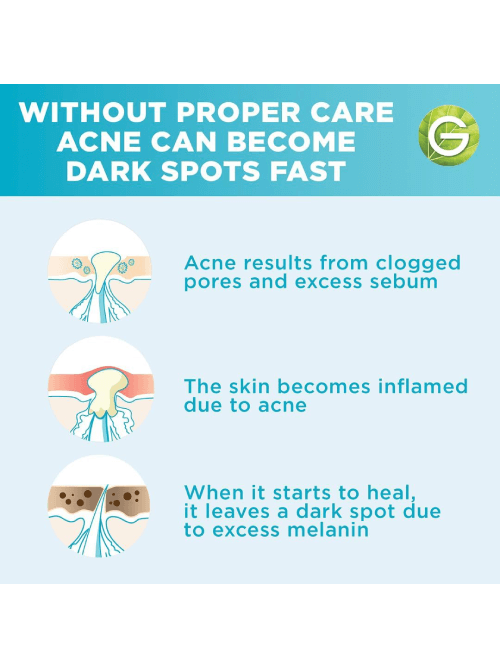 Fast Clear Info about Acne